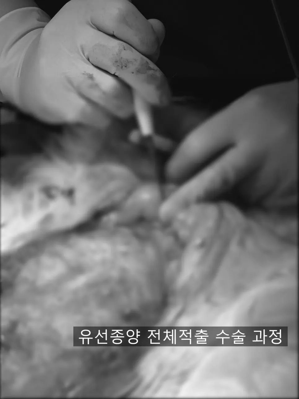 기구로 조직을 조금씩 떼어 내며 경계를 정리하는 과정입니다.