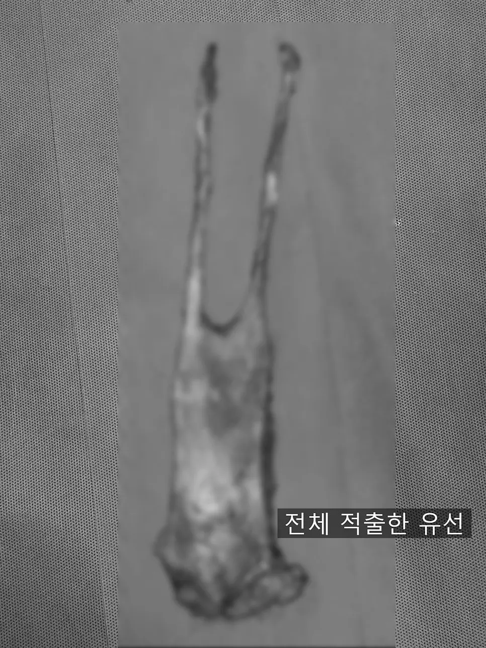 통째로 들어낸 유선 조직입니다. 좌우로 길게 이어진 형태가 그대로 남아 있습니다.