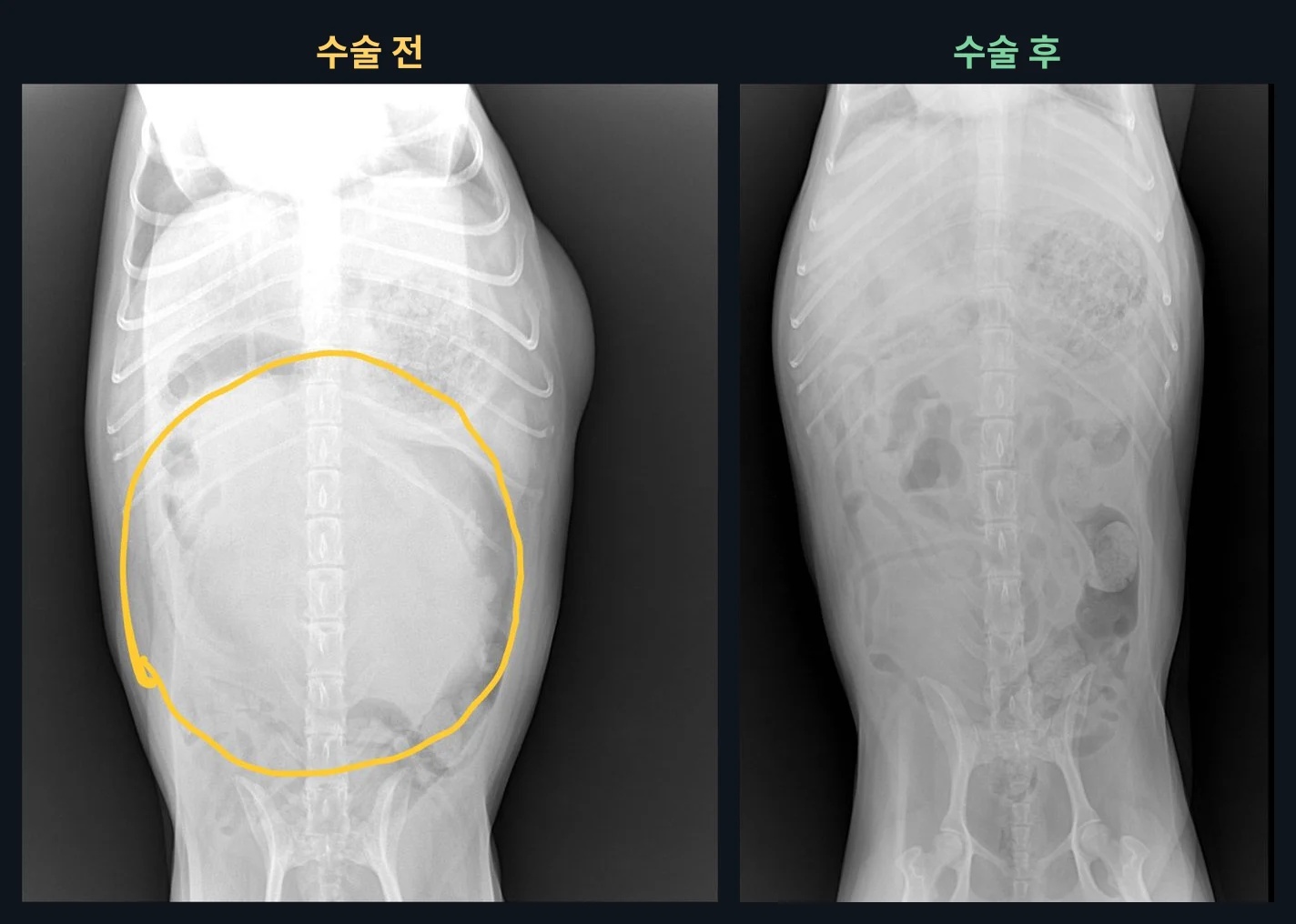복배상 촬영 비교입니다. 종괴에 밀려 보이지 않던 장기 윤곽과 장 가스 무늬가 다시 보입니다.