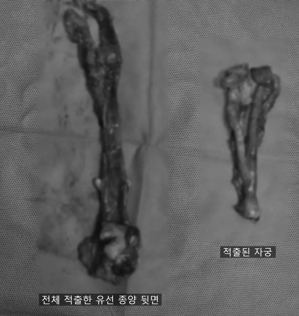 전체 적출한 유선 종양 뒷면, 그리고 함께 나온 자궁