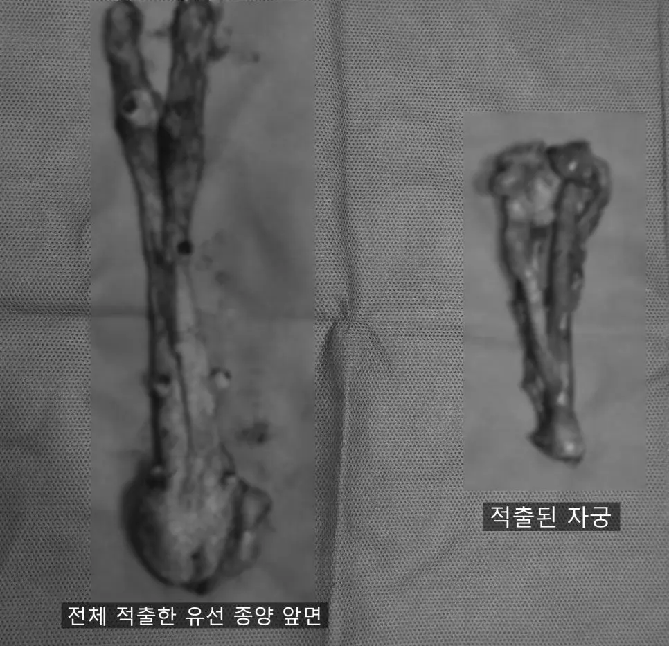 전체 적출한 유선 종양 앞면과 적출된 자궁
