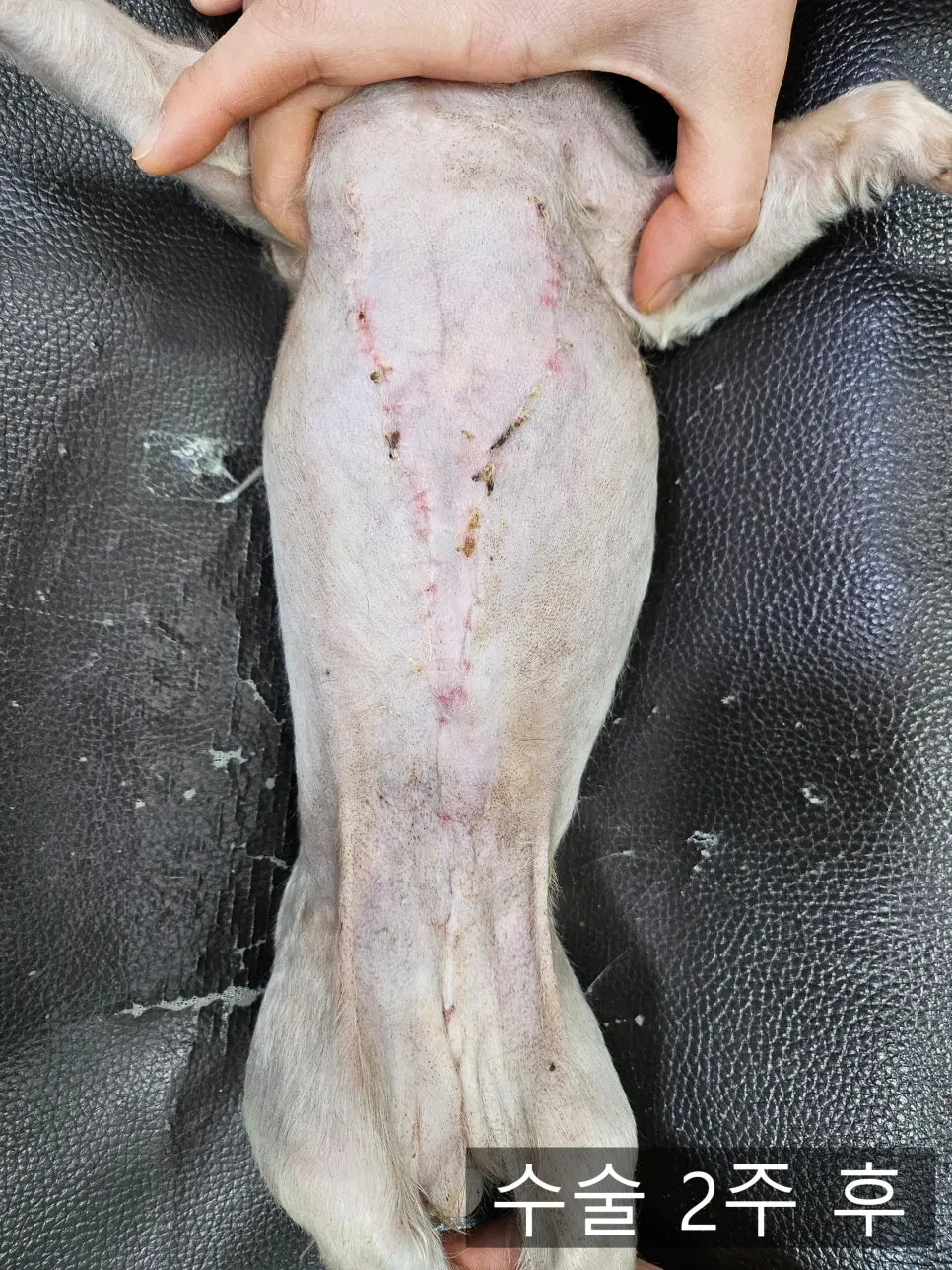 수술 2주 후, 봉합사를 모두 제거한 상태