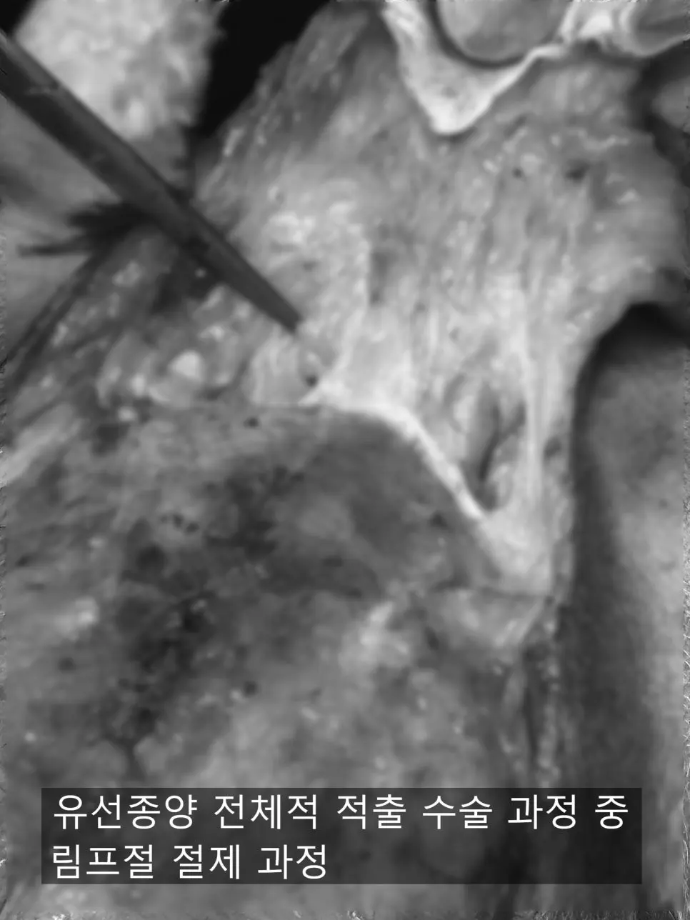 이어져 있는 림프절을 함께 걷어내는 장면입니다.