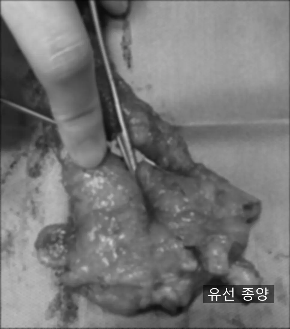 적출한 조직은 그대로 조직검사에 보냈습니다.