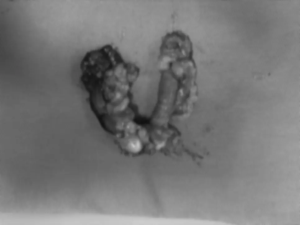 좌우 양쪽에서 걷어낸 유선 조직을 함께 늘어놓은 모습입니다.