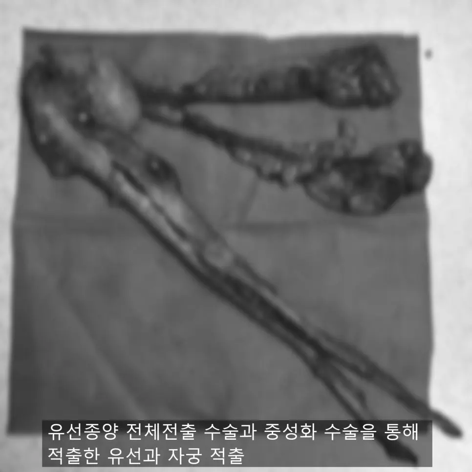 적출한 유선 조직