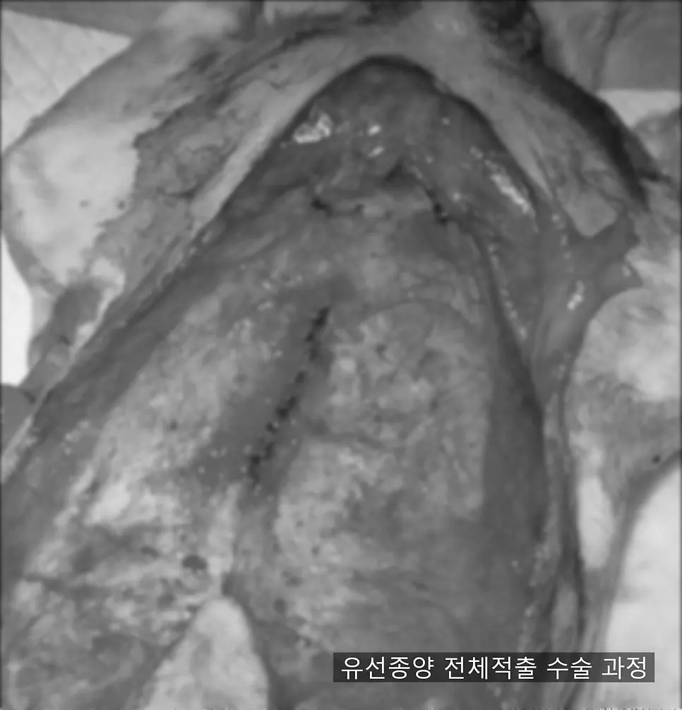 젖샘 전체를 들어내는 적출 수술 진행 장면