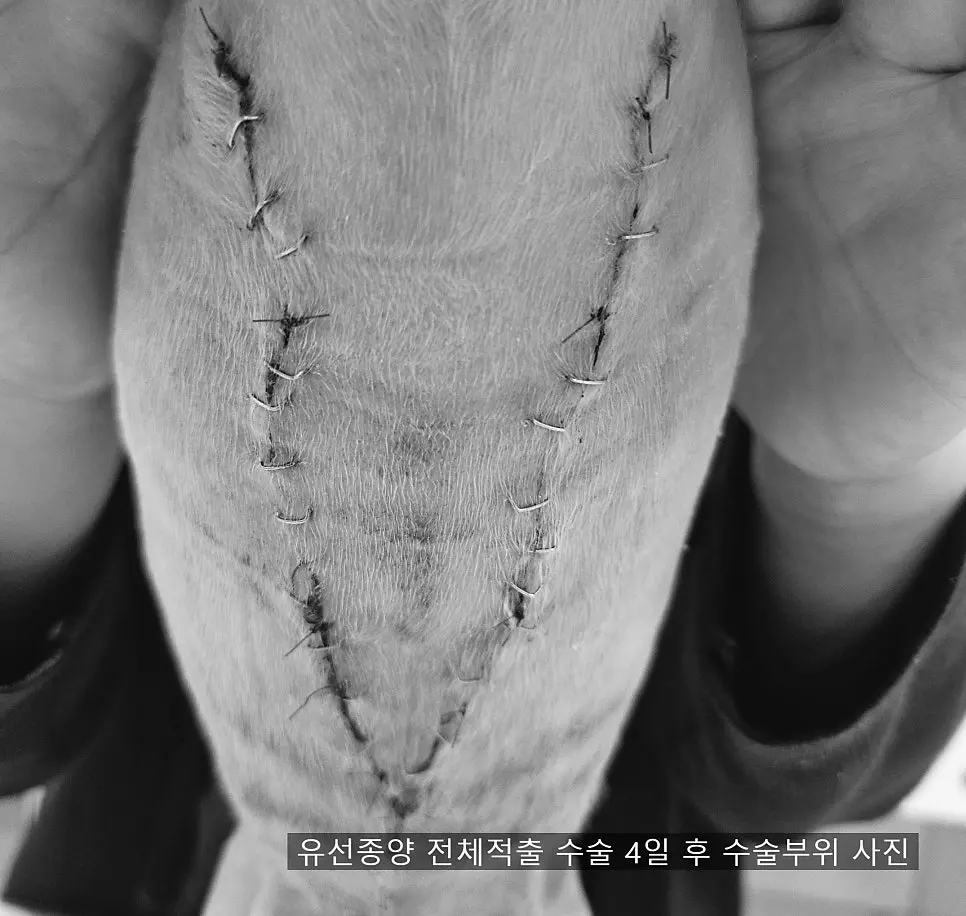 수술 4일 후, 봉합사가 그대로 남아 있는 절개 자리