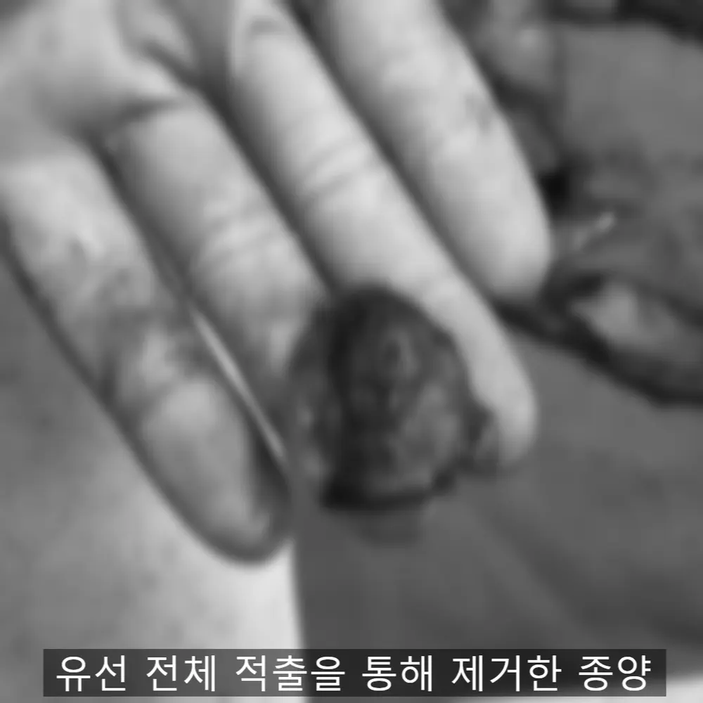 전체 적출로 제거한 유선 종양