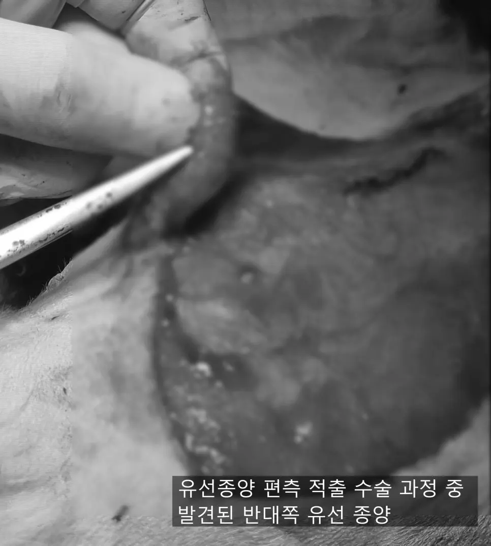 수술 중 반대쪽 유선에서 확인된 종양