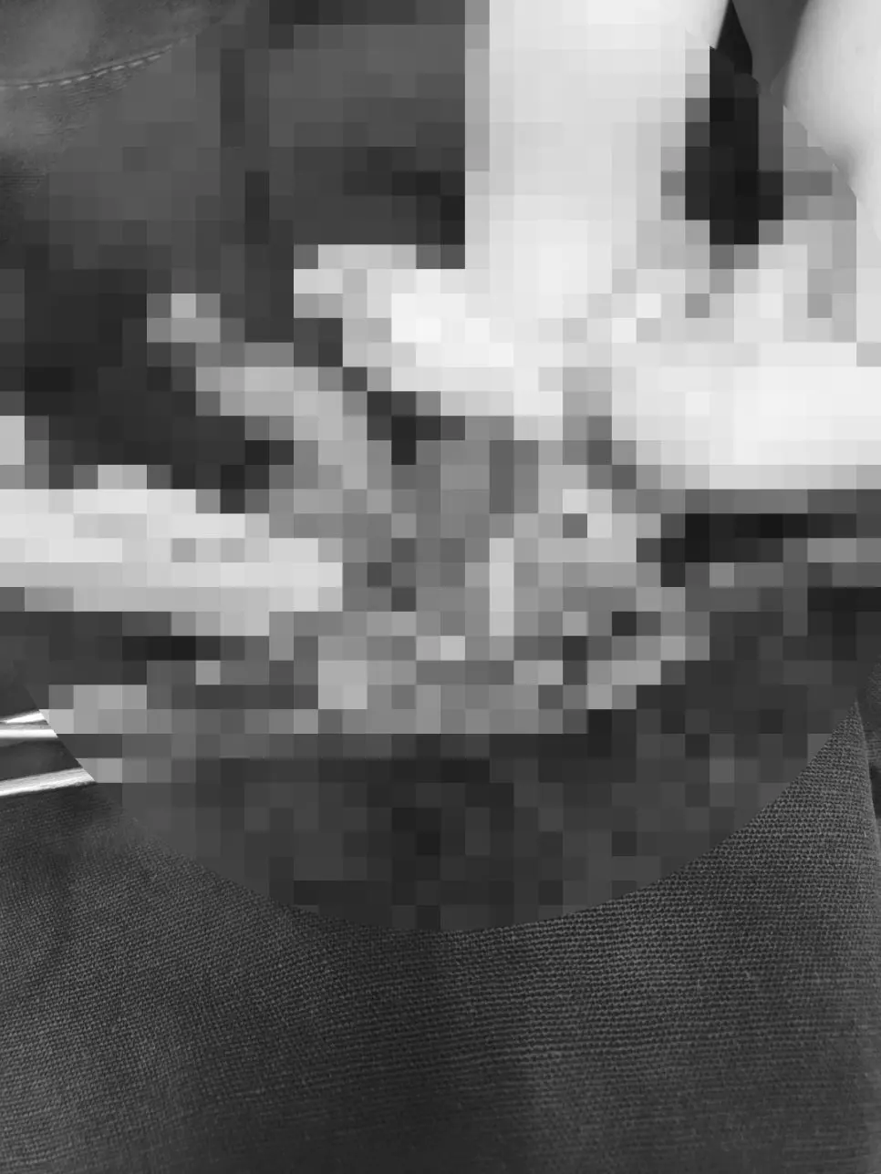 떼어낼 범위를 확인하며 조직을 분리하는 과정입니다.